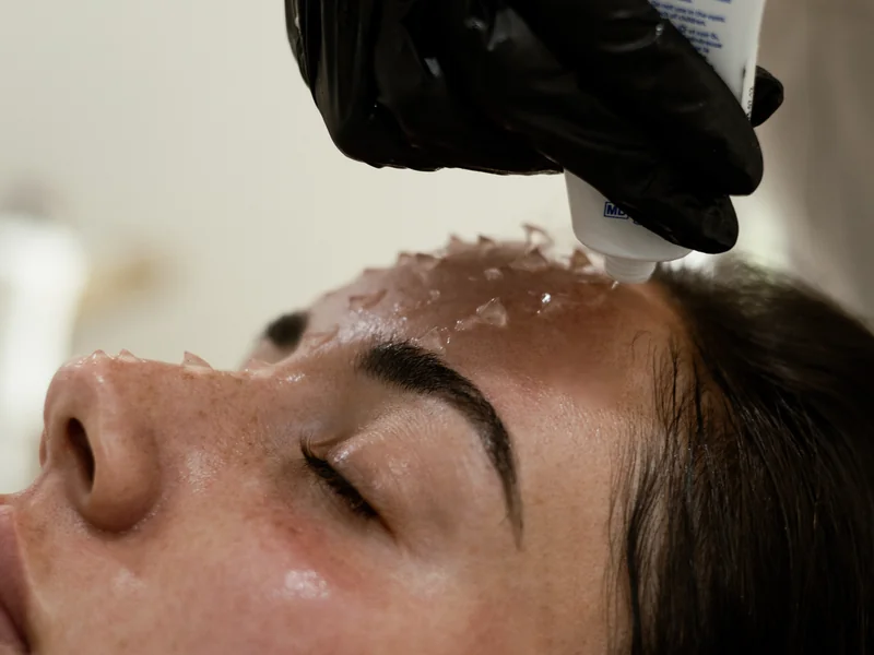 Medical-grade chemical peel treatment